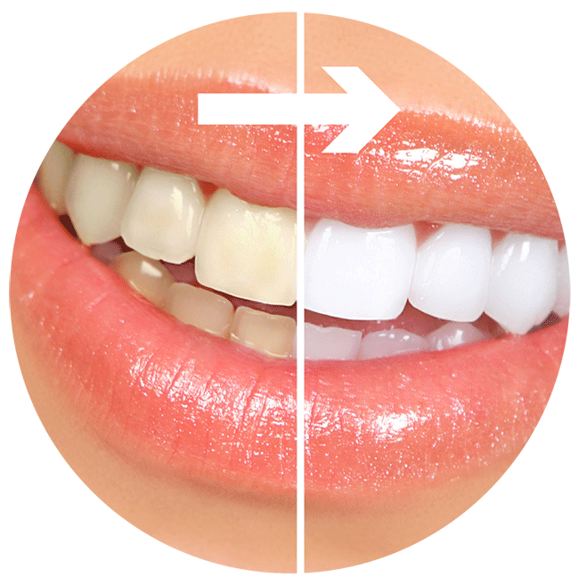 teeth-whitening